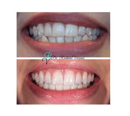 Before and after Invisalign results