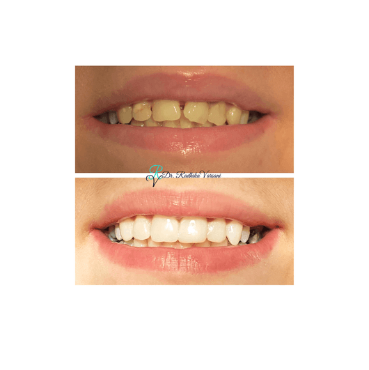 Before and after Invisalign results